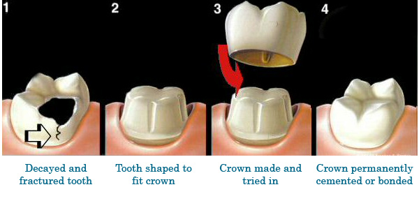 Dental Crowns & Bridge Albuquerque