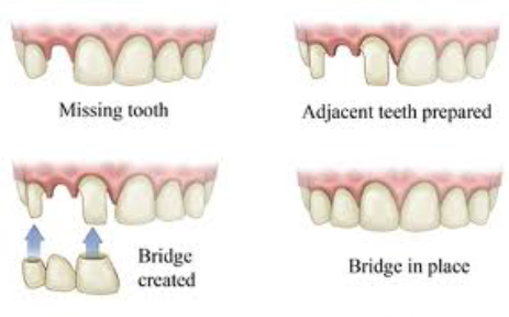 Dental Crowns & Bridge Albuquerque