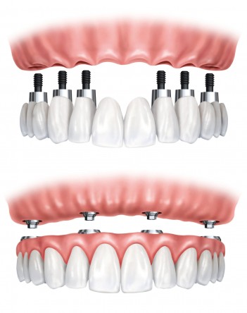 Best Dental Implants in Albuquerque