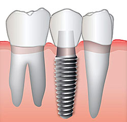 Best Dental Implants in Albuquerque