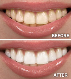 Teeth Whitening Albuquerque