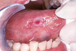 Dental Oral Cancer Screening in Albuquerque
