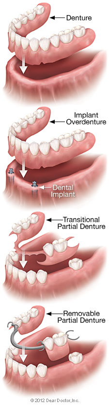 Removable Dentures in Albuquerque