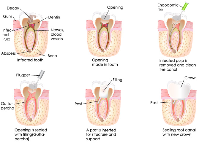 Root Canal Treatment in Albuquerque