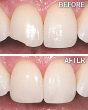 Dental Bonding Albuquerque