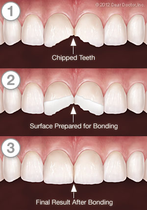 Dental Bonding Albuquerque