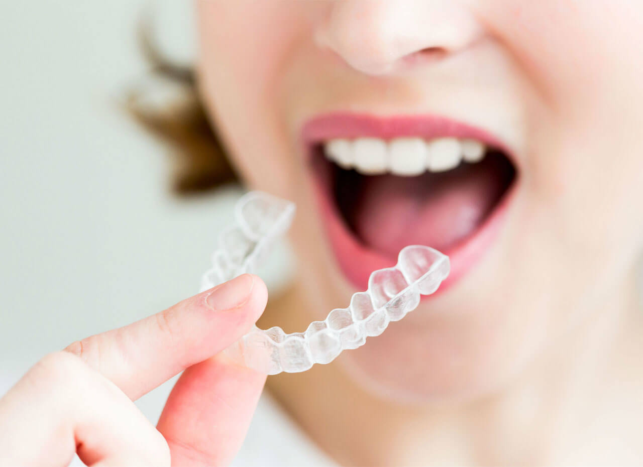 Are Invisalign Aligners More Effective Than Braces