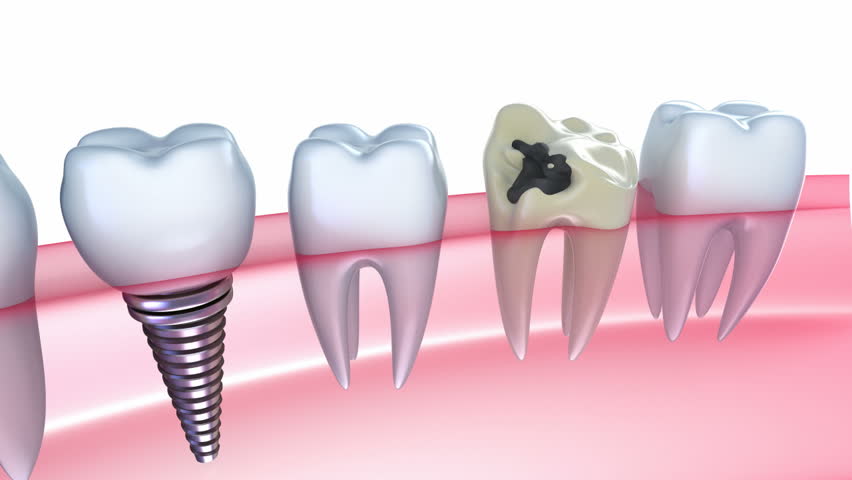 Delightful Advantages of Dental Implants