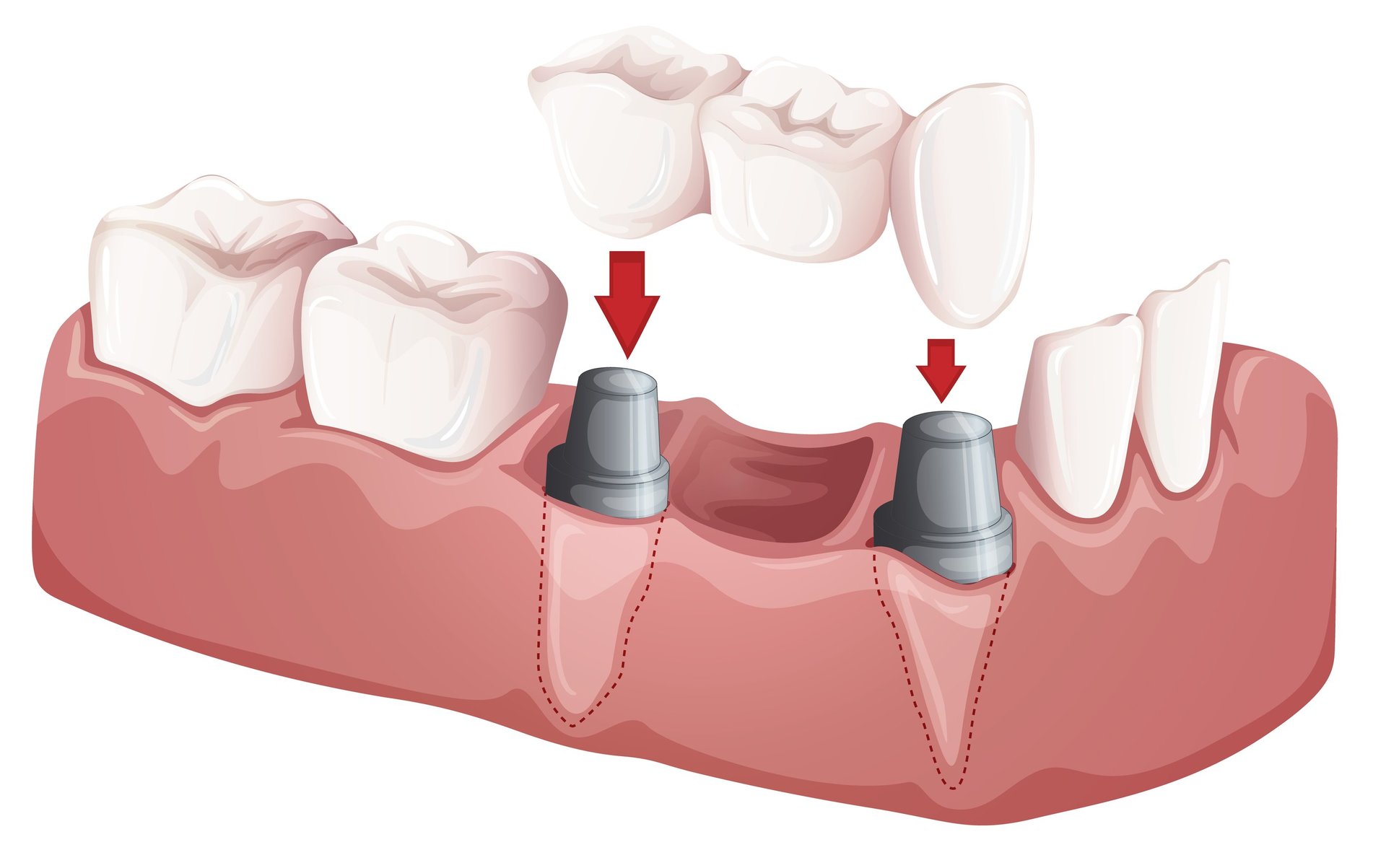 Different Types of Dental Bridges and Crowns