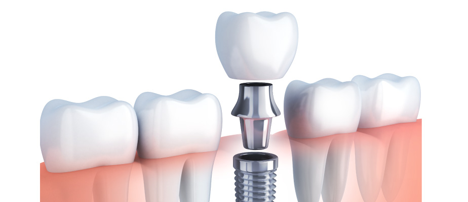 What is a Dental Implant