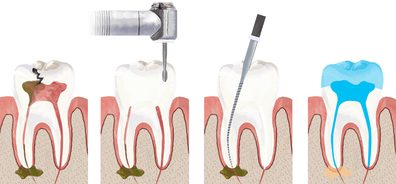 Facts You Need to Know About Root Canal Treatment