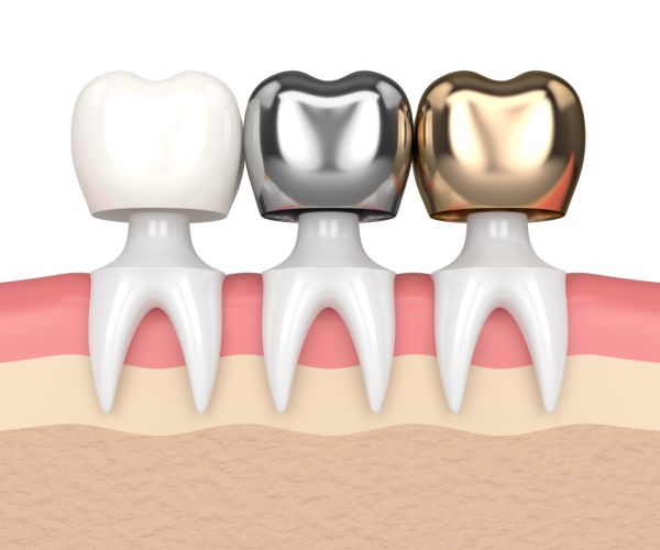 Bring Smile at Dental Crown Albuquerque