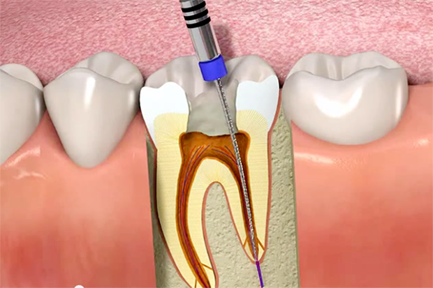 Cost-effective Root Canal Therapy